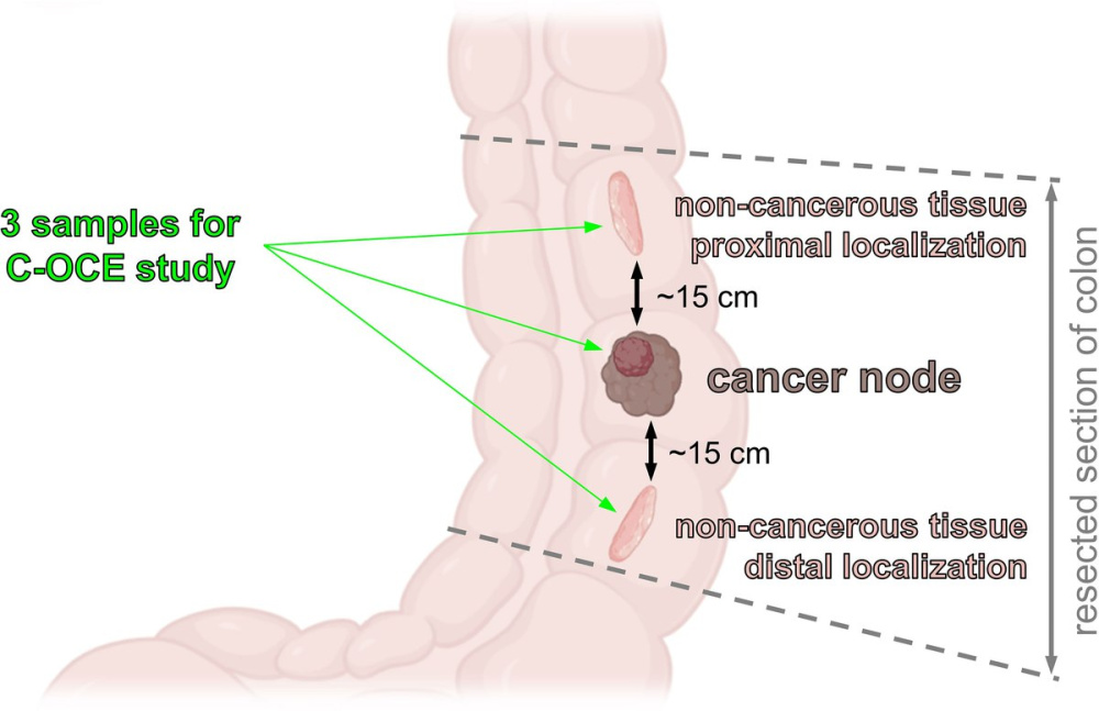 Нижегородские ученые предложили метод сверхбыстрой диагностики колоректального рака